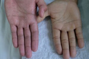 Kenali Gejala Anemia Akibat Kekurangan Zat Besi, Tanda-Tanda Tubuh Kurang Hemoglobin dan Cara Meningkatkan Kadar Zat Besi agar Energi dan Kesehatan Tubuh Tetap Optimal